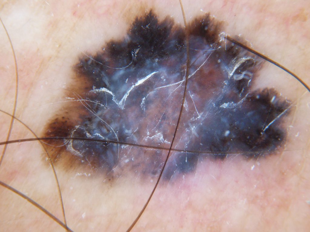 melanoma-skin-cancer-skin-checks