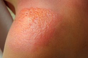 sunburn-skin-cancer