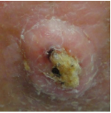 squamous-cell-skin-cancer